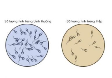 Tinh trùng ít dẫn đến vô sinh