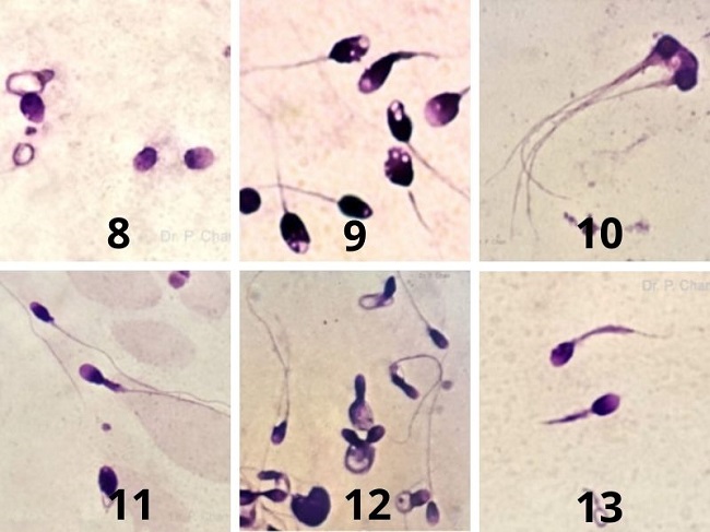Các loại hình thái tinh trùng: Tinh trùng không có đuôi (8); Tinh trùng đầu có nhiều không bào (9); Tinh trùng nhiều đầu hoặc nhiều đuôi (10); Tinh trùng cổ dày (11), Tinh trùng đuôi cuộn (12); Tinh trùng đuôi gốc (13)