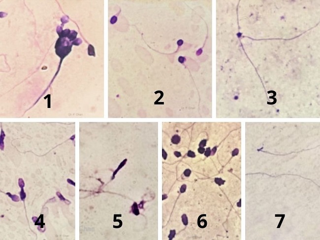 Các loại hình thái tinh trùng: Tinh trùng đầu to (1); Tinh trùng đầu nhỏ (2); Tinh trùng đầu kim (3); Tinh trùng đầu thon (4); Tinh trùng đầu mỏng (5); Tinh trùng đầu tròn (6); Tinh trùng không đầu (7)