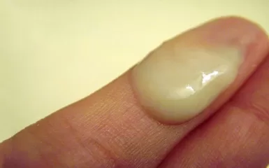 Tinh trùng vón cục màu vàng cảnh báo bệnh gì? Có điều trị được không?