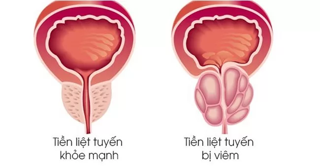 Viêm tuyến tiền liệt là có thể khiến tinh trùng bị vón cục