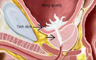 Title Xuất tinh ngược là gì? phải làm sao để xử lý?