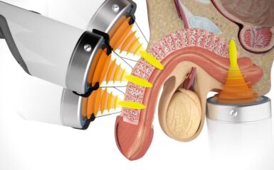 Quy trình điều trị xuất tinh sớm bằng sóng cao tần