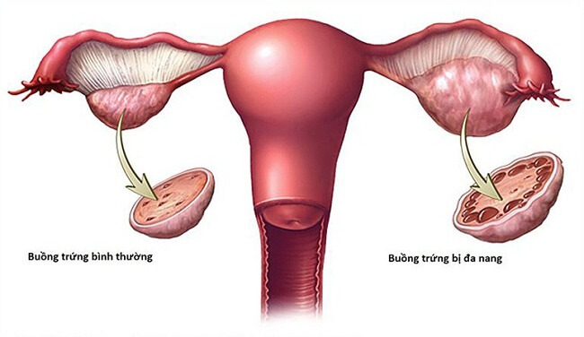 Hội chứng buồng trứng đa nang là nguyên nhân chính gây hiếm muộn ở phụ nữ