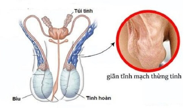 giãn tính mạch thừng là nguyên nhân chính gây khó thụ thai ở nam do làm giảm khả năng sản xuất tinh trùng