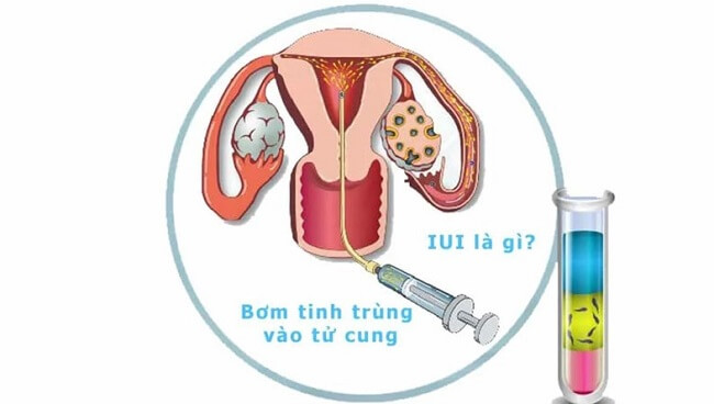 Tìm hiểu kỹ về phương pháp thụ tinh nhân tạo chính là cách giúp bạn tăng tỷ lệ thành công khi làm IUI