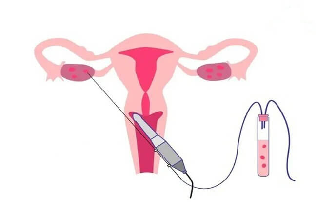 Qúa trình chọc hút noãn được thực hiện dưới hướng dẫn của siêu âm đầu dò