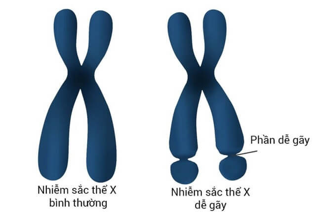 Hội chứng Fragile X