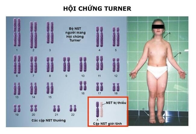 Hội chứng Turner