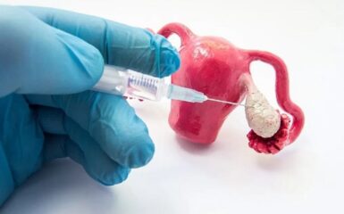 Tìm hiểu về kỹ thuật hỗ trợ sinh sản IVM
