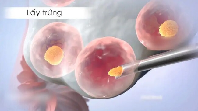 Chọc hút trứng