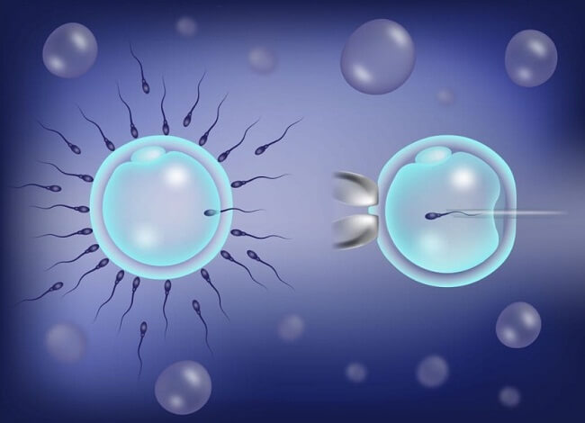 Cách thức thụ tinh trong phương pháp ICSI (phải) và IVF (trái)