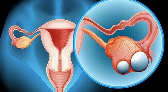 Kích thước buồng trứng càng to thì nguy cơ xoắn buồng trứng càng tăng