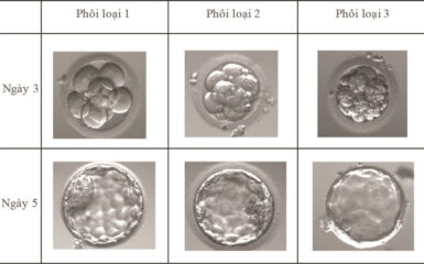 Tổng quan về phân loại phôi trong IVF