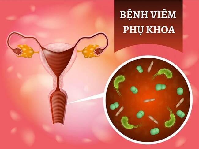 Viêm nhiễm phụ khoa có thể là nguyên nhân gây sảy thai