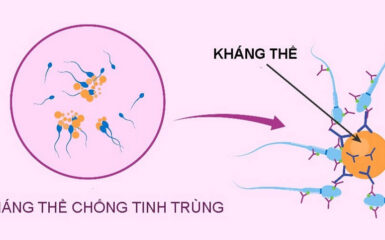 Kháng thể kháng tinh trùng: Nguyên nhân, chẩn đoán, cách điều trị