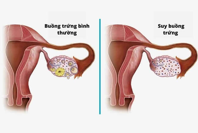 Hình ảnh mô tả sự suy giảm dự trữ buồng trứng ở một số chị em hiện nay