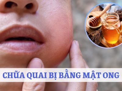 Các cách chữa quai bị bằng mật ong