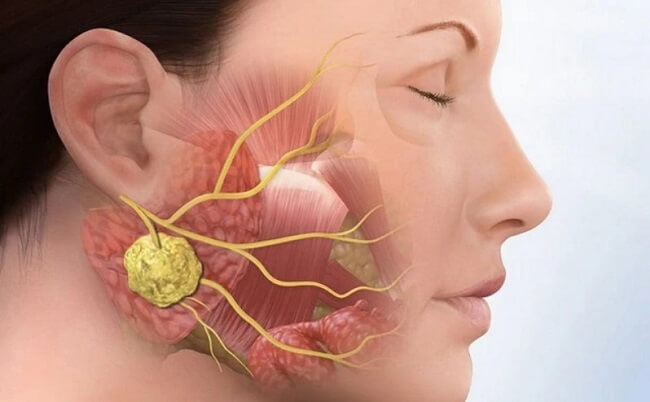 Nguyên nhân gây quai bị là gì?