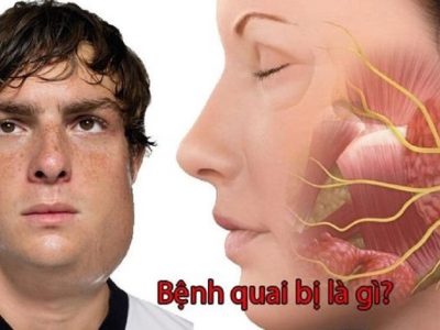 7 điều quan trọng nhất cần biết về Quai bị