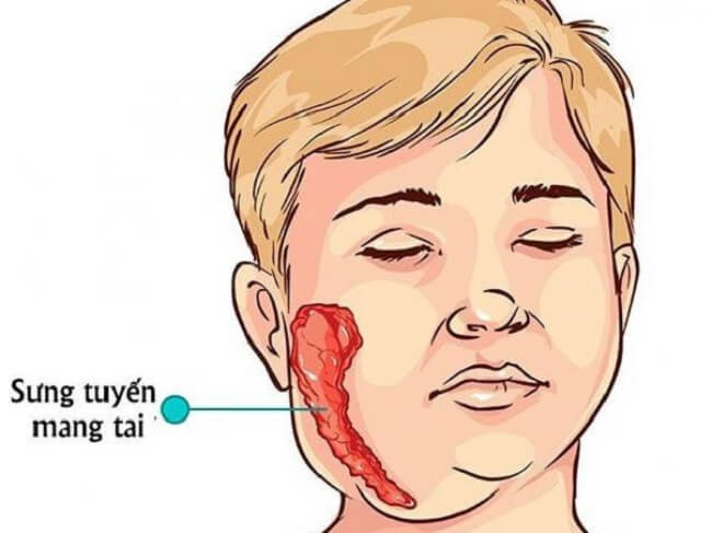 Quai bị là căn bệnh truyền nhiễm cấp tính do virus gây ra với biểu hiện đặc trưng là sưng tuyến nước bọt