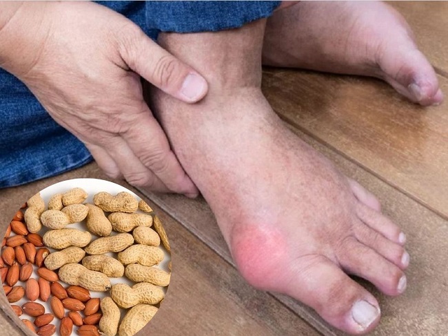 Lạc có thể khiến tình trạng bệnh gout trở nên trầm trọng hơn