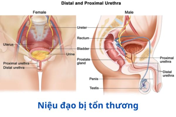 Nguyên nhân gây viêm ống dẫn tinh có thể là do niệu đạo bị tổn thương