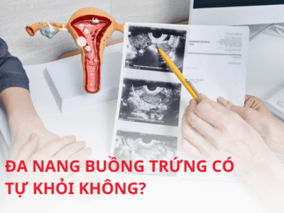 Tìm hiểu đa nang buồng trứng có tự khỏi không