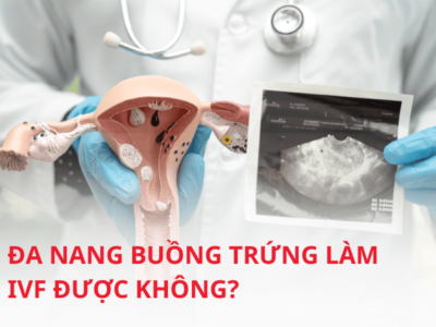 Tìm hiểu đa nang buồng trứng làm IVF được không