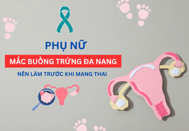 Những điều phụ nữ mắc PCOS nên làm trước khi muốn có thai
